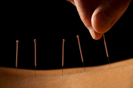 acupuncture denver co
